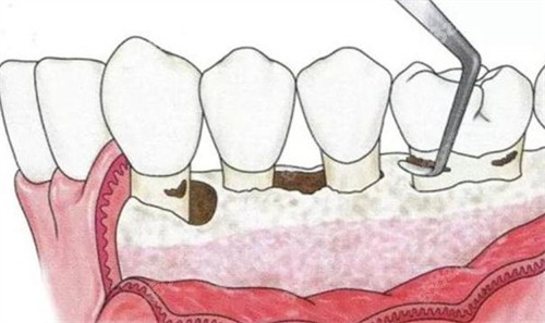 祛除牙垢过程图解