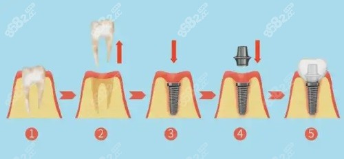 种植牙过程图片