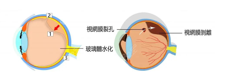 后巩膜加固术