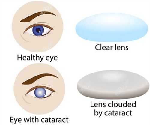 白内障和正常眼球的区别图解