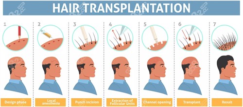 头发种植的过程