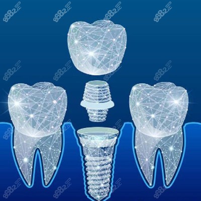 种植牙数字化模拟图