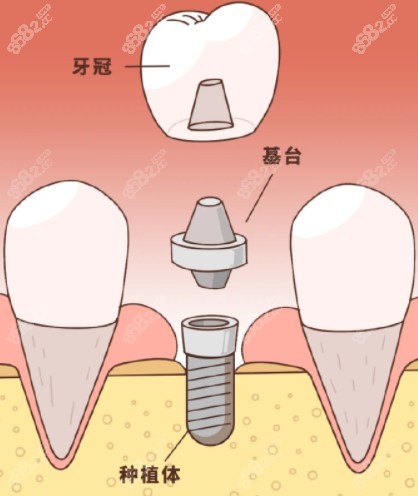 种植牙的组成部分
