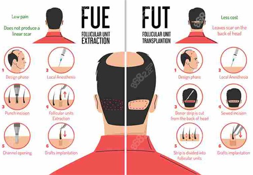 FUE和FUT植发方式对比