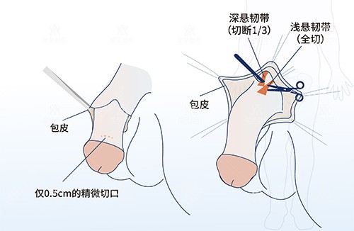 男性阴茎延长手术切口及手术过程