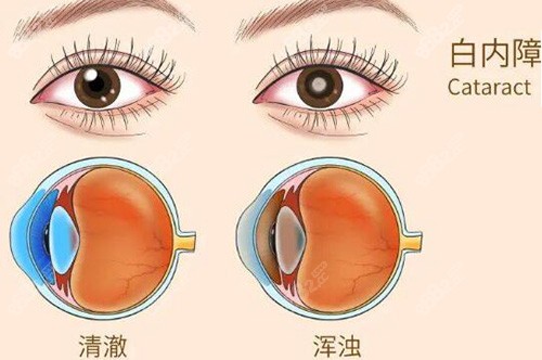 白内障眼睛对比展示卡通图