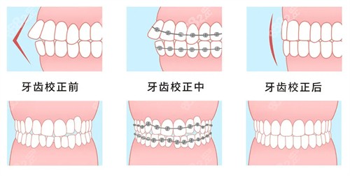 金属牙齿矫治过程图解