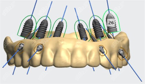 数字化种植牙模拟图