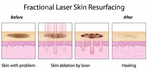 激光改善皮肤斑点和疤痕