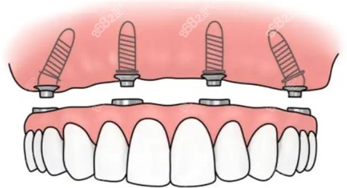 半固定种植牙卡通图