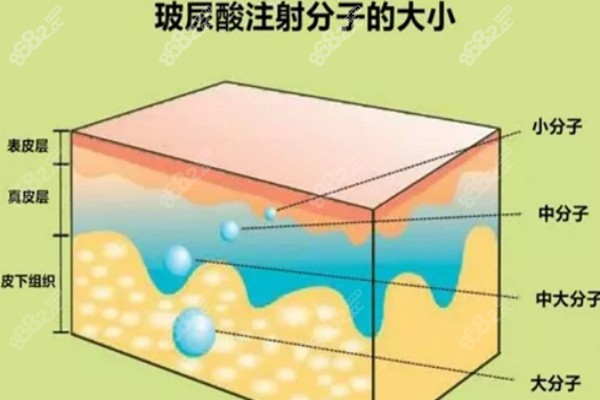 <!--<i data=20240705-sp></i>-->玻尿酸深层注射