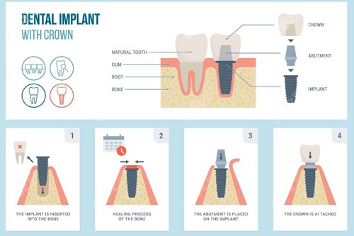 牙齿种植过程图解