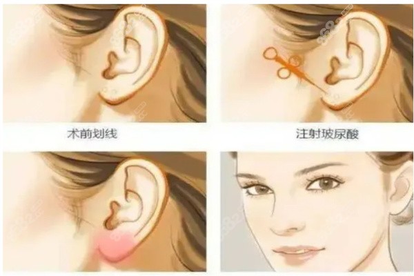 <!--<i data=20240705-sp></i>-->玻尿酸注射整形
