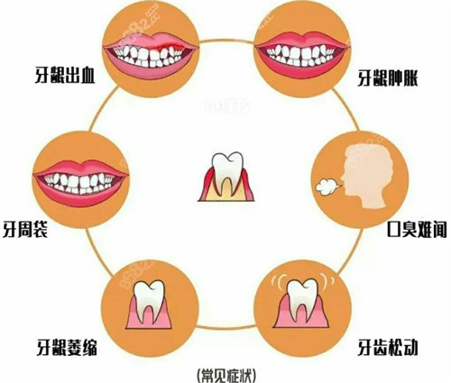 牙周疾病类型照片