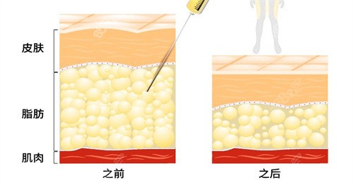 吸脂前后