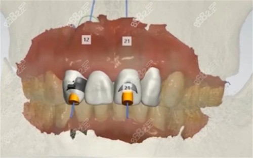 种植牙数字化设计图