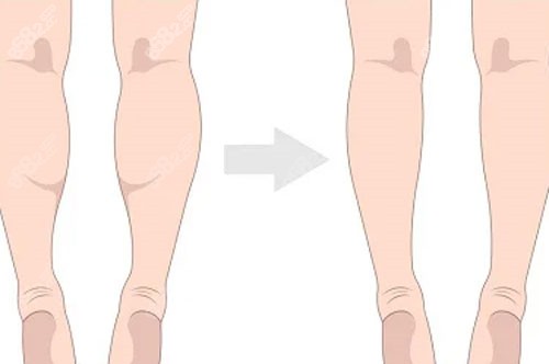 腿部吸脂