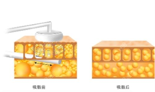 吸脂前后对比图