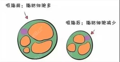 吸脂过程示意图