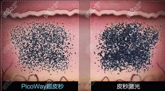 深圳超皮秒祛斑正规医院推荐