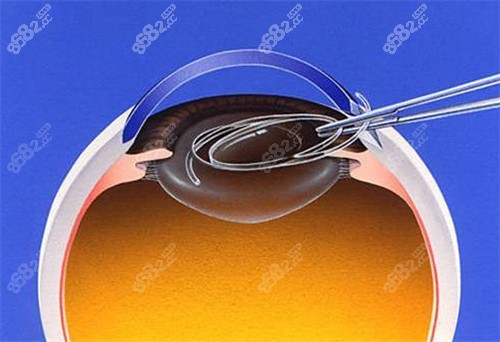 20240322239275.jpg 白内障晶体展示图.jpg