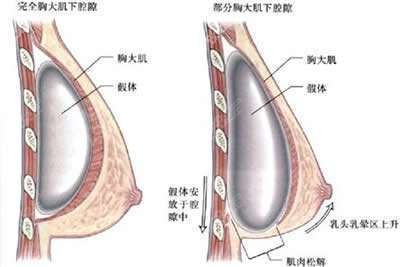 隆胸假体植入层次