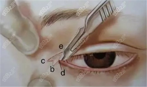 眼角手术切口角度分析