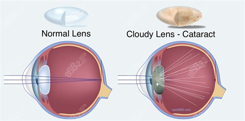 白内障跟正常眼睛结构对比 白内障跟正常眼睛结构对比