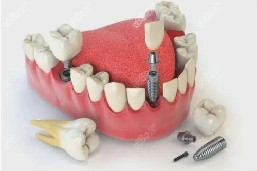 种植牙医生技术很关键