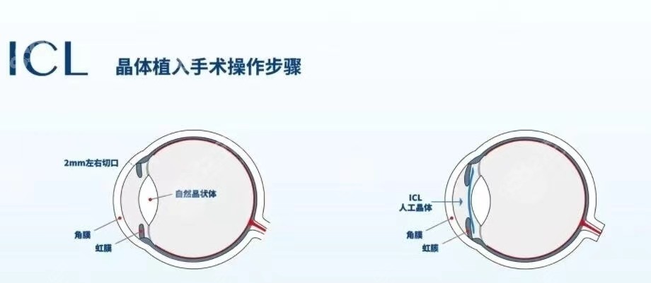 ICl中外合资晶体植入品牌分享