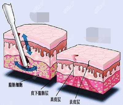 吸脂手术脂肪层次漫画示意图