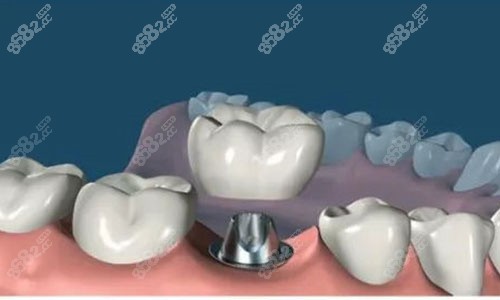 种植牙动画示意图