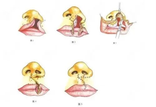 国内唇腭裂价格表