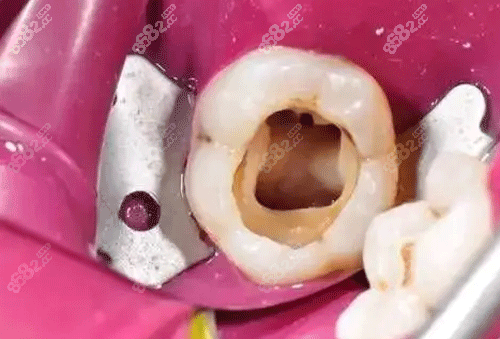 牙齿根管治疗细节图