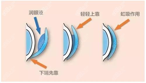 角膜塑形镜佩戴方式示意图