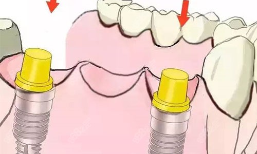 种植牙植体植入动画展示图
