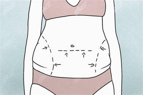 腰腹部吸脂部位漫画示意图