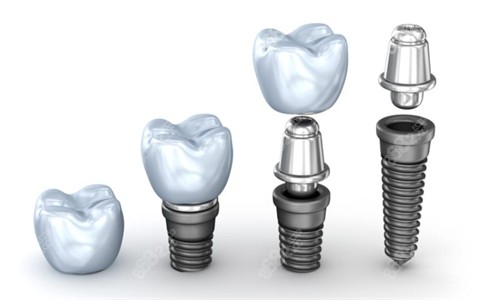 种植牙的组成