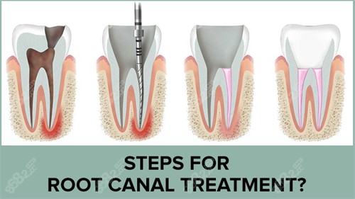 对龋坏的牙齿进行根管治疗