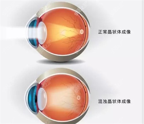 白内障晶体表现照片