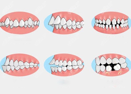 需要进行矫正的牙齿问题卡通示意图
