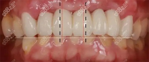 牙齿修复数据测量