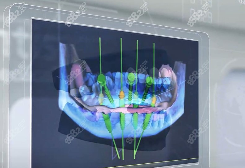 allon4数字化种植牙演示图