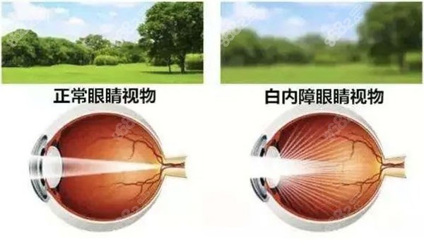 如何申请白内障手术免费资质