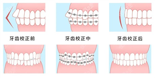 金属正畸过程图解