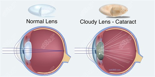 白内障图示.jpg