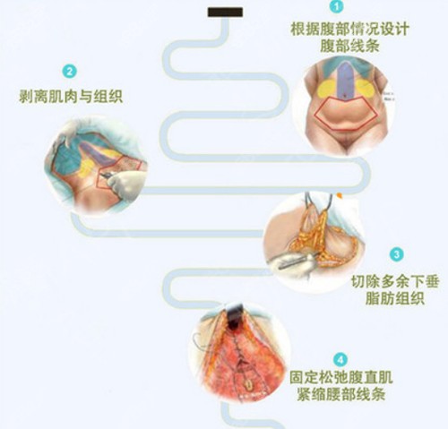 腹壁成型术过程图.jpg