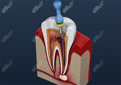 根管治疗中的坏牙