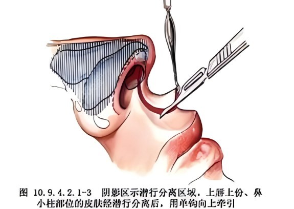 唇腭裂修复手术方法