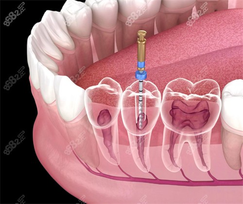 根管治疗修复坏牙